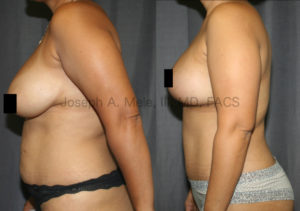 Mommy Makeovers in breast and belly enhancement in one surgery.