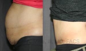 Tightening the skin removes any skin that folds over. The above Abdominoplasty Before and After Pictures