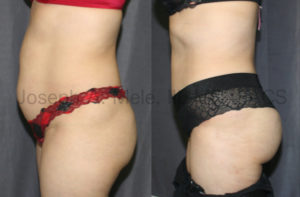 The patient above has very little excess skin and fat; however, her muscles are stretched out of shape. A Tummy Tuck was used to tighten her abdominal wall, like an internal corset. Also, the excess fat she had was used to reshape her buttocks with a Brazilian Butt Lift.