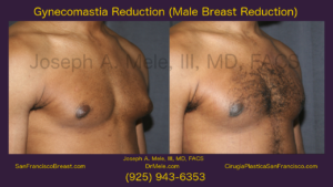Gynecomastia Reduction Video with Male Breast Reduction Before and After Photos