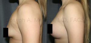 Breast Augmentation Lift for Tubular Breasts