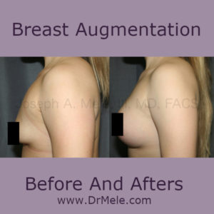 Breast Augmentation Before and After Pictures (Breast Implants)