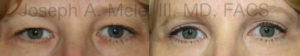 Upper blepharoplasty removes excess upper eyelid skin - before and after pictures