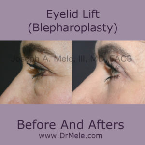 Eyelid Lift (Blepharoplasty) Before and After Pictures