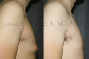 Gynecomastia Reuctiob for Tubular Breasts before and after photos.