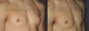 Before and after photos of Gynecomastia Reduction for the asymmetrical male chest.