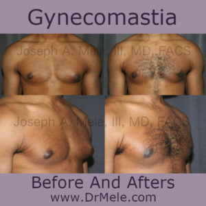 Gynecomastia Reduction before and after pictures