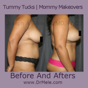 Tummy Tuck Before and After Pictures (Abdominoplasty)