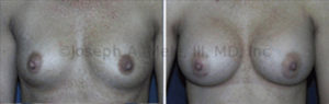 Breast Augmentation Before and After - Front View