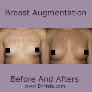 Breast Augmentation Before and After Pictures (Breast Implants)