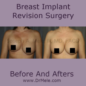 Breast Implant Revision Surgery Before and Afters