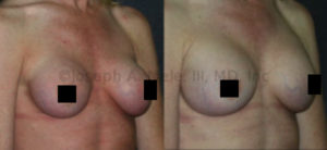 Breast Augmentation Revision for Capsular Contracture Bilateral