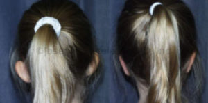 Ear Pinning For Children 5 or older - before and after pictures