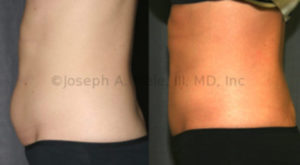 Liposuction of the Abdomen