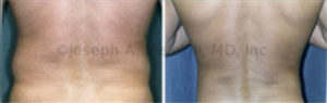 Liposuction of the Back (Love Handles)