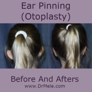 Otoplast (Ear Pinning) Before and After Pictures