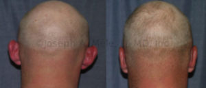 Otoplasty for Prominent Ears - Before and After Photos