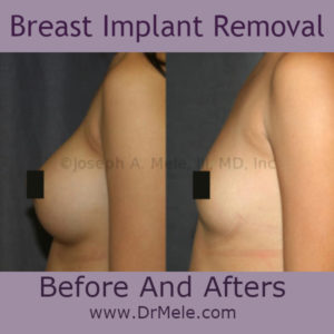 Breast Implant Removal Before and Afters