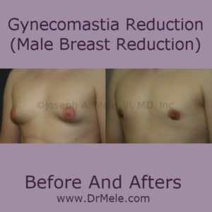 Gynecomastia Reduction (Male Breast Reduction) Before and After Pictures