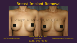 Breast Implant Removal Video with Before and After Pictures