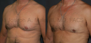 Male Breast Reduction after massive weight loss - post-bariatric plastic surgery before and after pictures