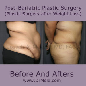 Plastic Surgery after extreme weight loss (postbariatric plastic surgery) Before and After Pictures