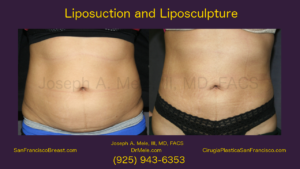 Liposuction Video with Before and After Pictures