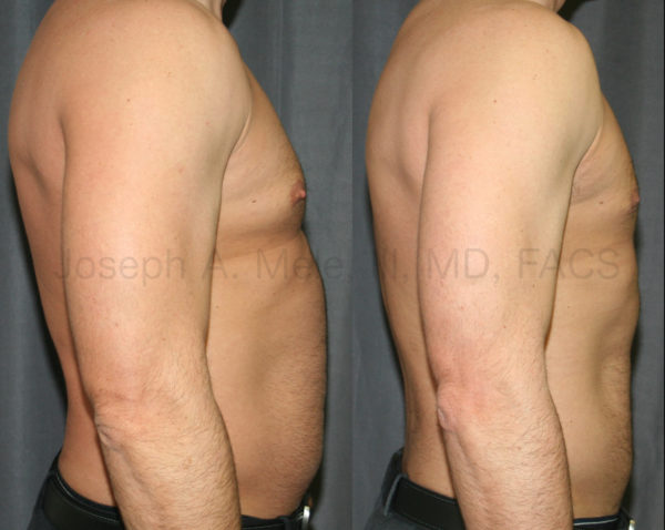 Liposuction Before and After Video