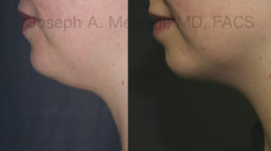 Liposuction before and after pictures of the neck and under the chin