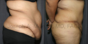 Massive Tummy Tuck before and after pictures