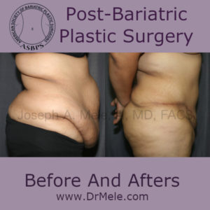 Post Bariatric Plastic Surgery after massive weight loss.