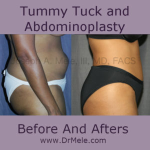 Tummy Tuck before and after pictures (Abdominoplasty)