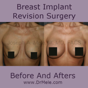 Breast Augmentation revision Surgery Before and After Pictures