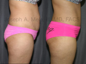 Tummy Tuck before and after pictures (Abdominoplasty)