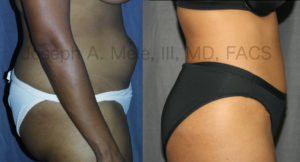 Tummy Tuck before and after pictures (Abdominoplasty)