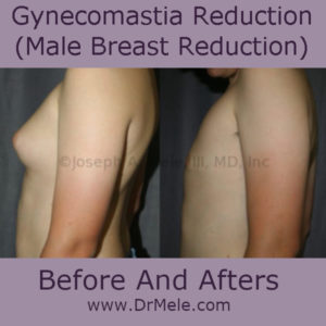 Male Breast Reduction before and after pictures (Male Breast Reduction)