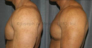 Gynecomastia Reduction before and after photos - body builder side view