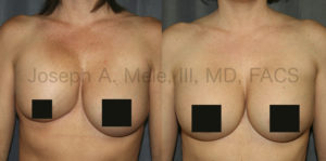 Breast Augmentation Revision Surgery for Capsular Contracture - Before and After Pictures