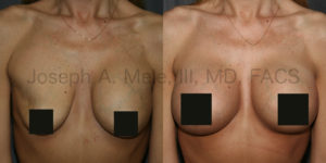 Saline Breast Implant Deflation Replacement Before and After Pictures