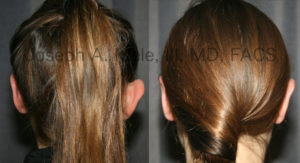 Otoplasty for asymmetrically prominent ears - before and after pictures