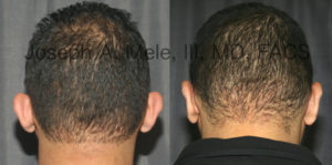 Male Otoplasty - Ear Pinning for Men - before and after photos