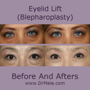 Cosmetic Eyelid Lift before and after pictures (blepharoplasty)