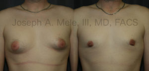Gynecomastia Reduction (male breast reduction) before and after pictures