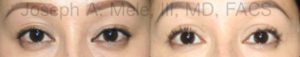 Asian double eyelid surgery before and after photos