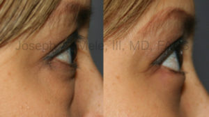 Lower eyelid lift before and after pictures