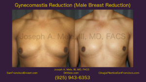 Male Breast Reduction (Gynecomastia Surgery) Video Presentation with Before and After Pictures