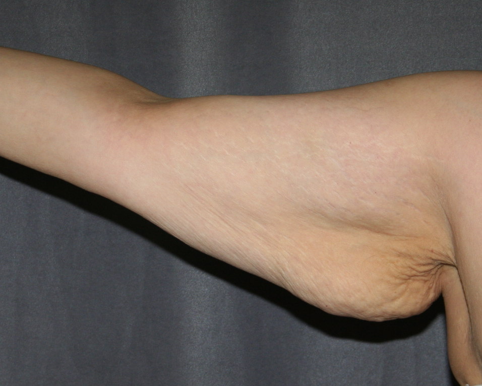 Right Arm after weight loss and before Arm Lift (Brachioplasty) 