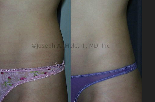 Female Muffin Top Removal - Liposuction of the Body