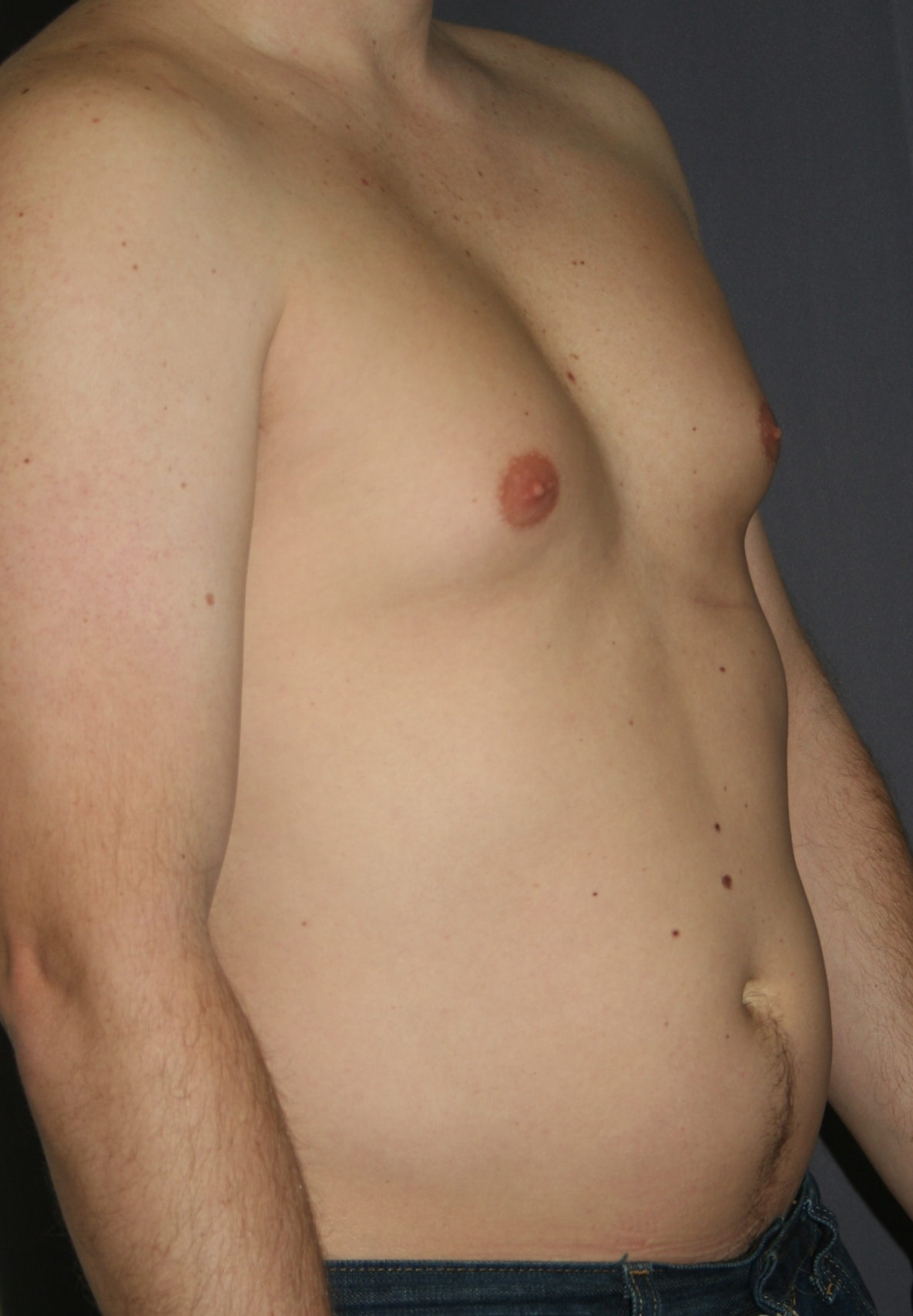 опухшая левая грудь у мужчин фото 118
