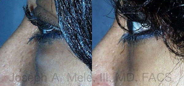 The Transconjunctival Lower Blepharoplasty before and after pictures above show how the lower eyelid is smoothed by removing the excess fat contained in the lower eyelid via an incision inside the eyelid.